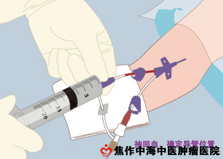 末端开口式picc导管(安全型picc导管)?picc的维护和管理有哪些?