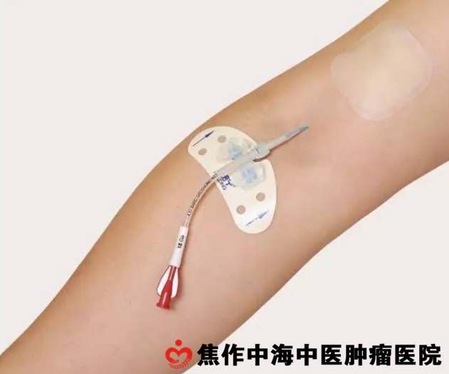 末端开口式picc导管(安全型picc导管)?picc的维护和管理有哪些?