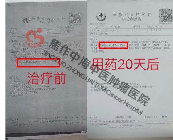 肝癌常九忠.jpg