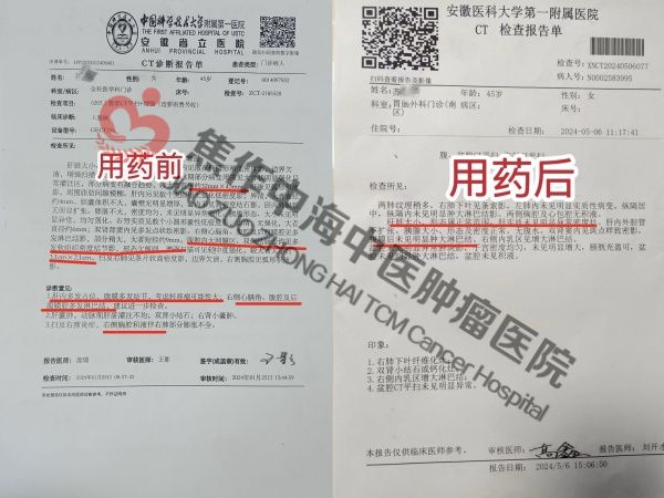 卵巢癌苏礼林.jpg