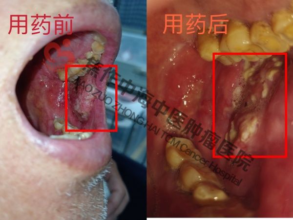 口腔癌师玉亭.jpg