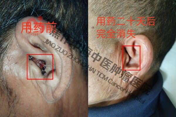 外耳道癌李合钦.jpg