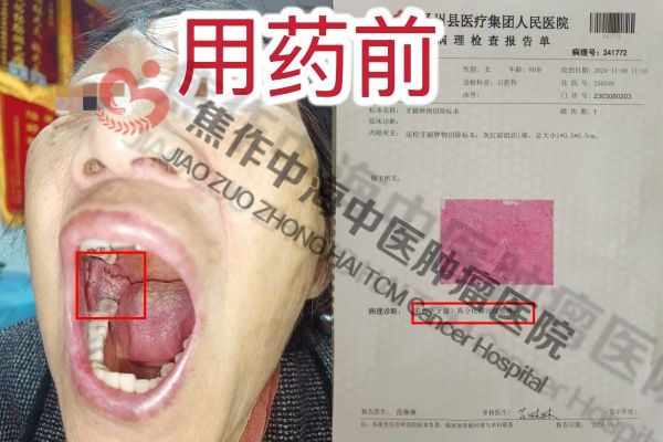 牙龈癌杜香娥1.jpg