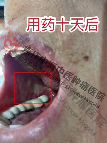 牙龈癌杜香娥2.jpg