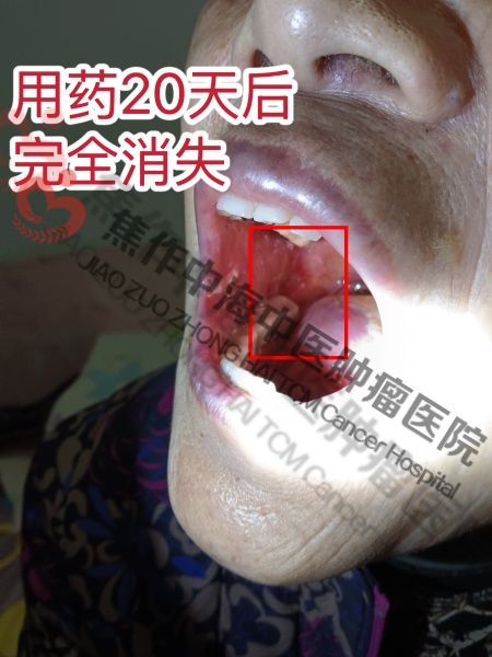 牙龈癌杜香娥3.jpg