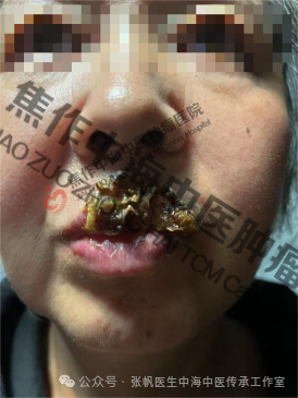 唇癌高玉花1.png