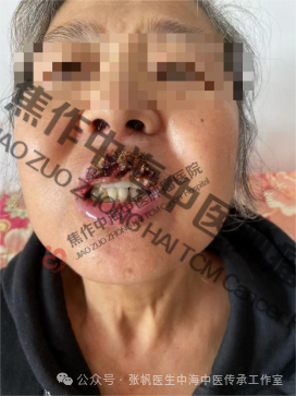 唇癌高玉花2.png