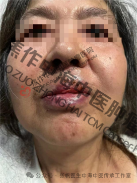 唇癌高玉花3.png
