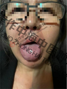 唇癌高玉花4.png