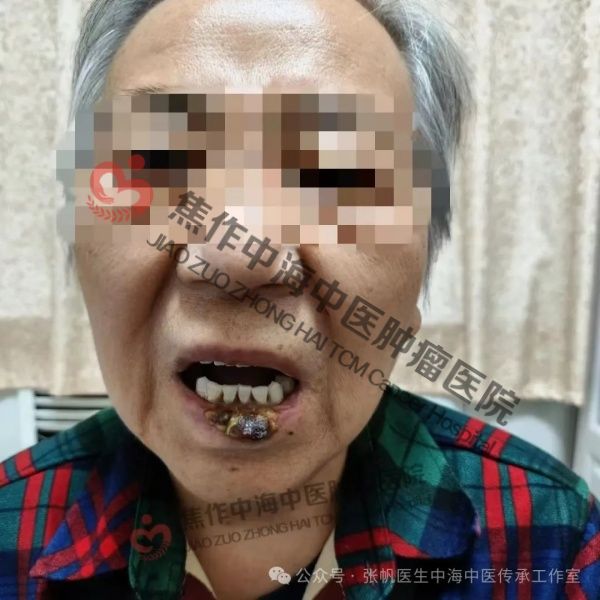 唇癌高玉花5.jpg