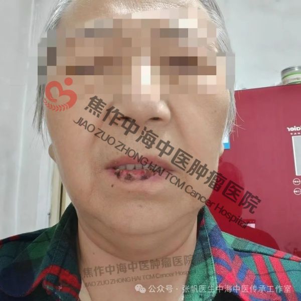 唇癌高玉花7.jpg
