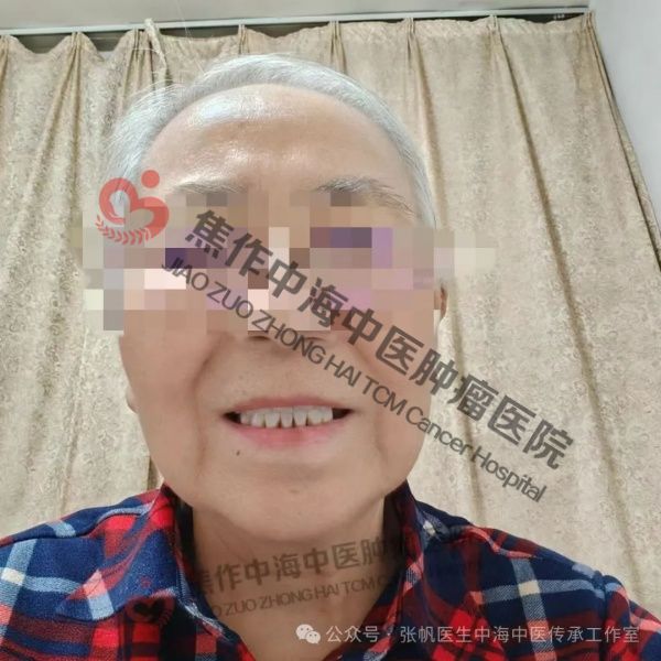 唇癌高玉花8.jpg