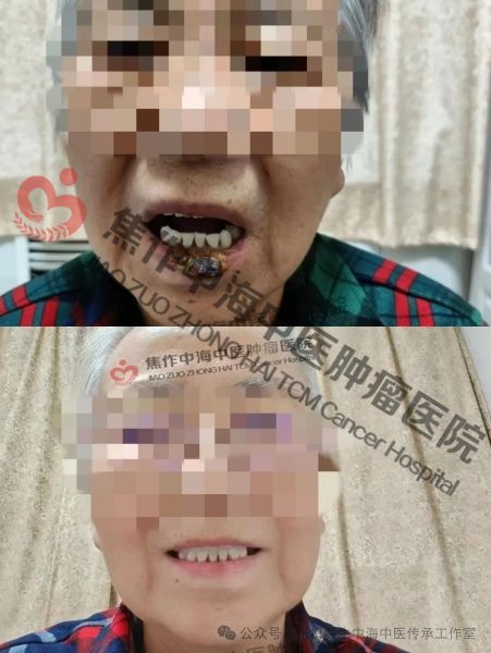 唇癌2.jpg