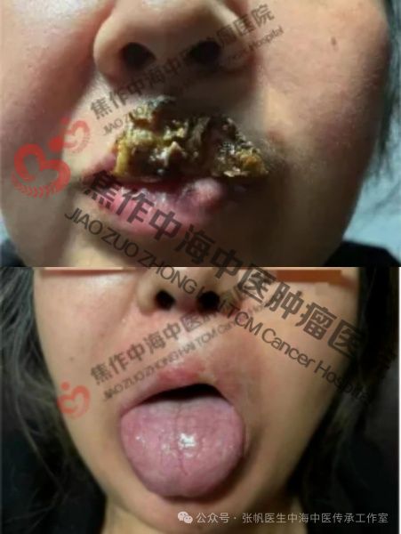 唇癌3.jpg
