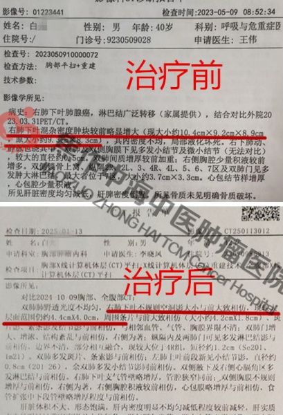 肺癌白光9.jpg