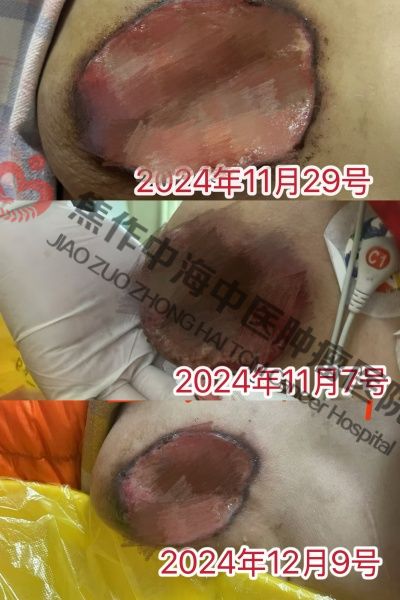 乳腺癌焦卫2.jpg