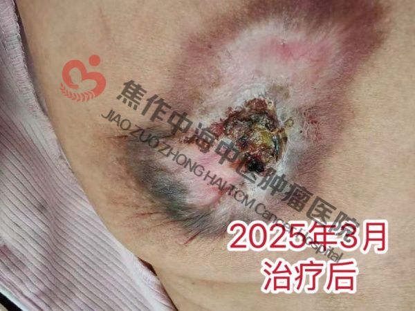 乳腺癌焦卫3.jpg