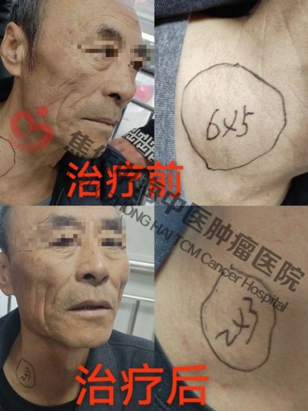 食道癌张军贵5.jpg