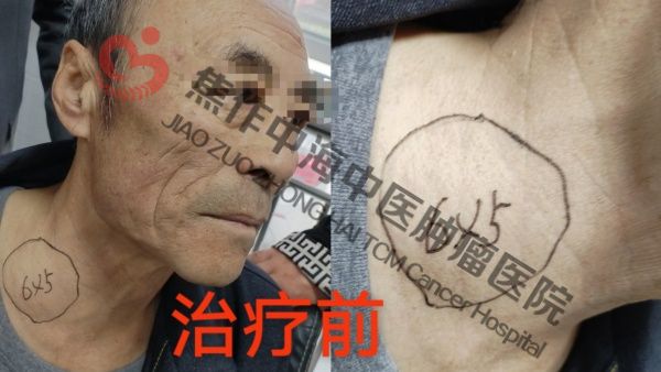 食道癌张军贵1.jpg