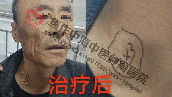 食道癌张军贵2.jpg