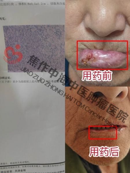 唇癌王俊田.jpg