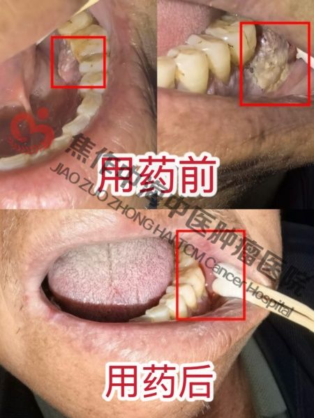牙龈癌黄中良9.jpg
