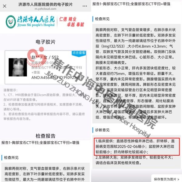 直肠癌赵宗梅.jpg