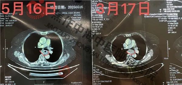 食道癌李万芳4.jpg