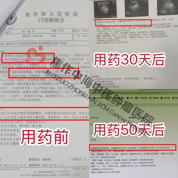 肺癌唐家齐.jpg