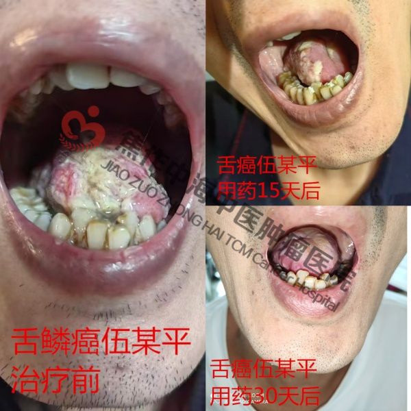 舌癌伍立平.jpg
