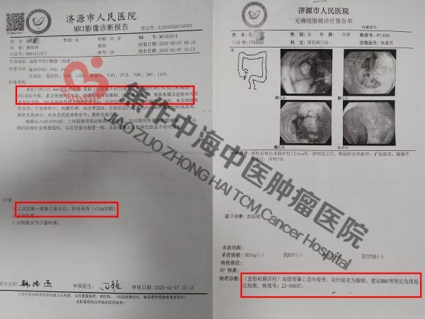 直肠癌赵宗梅1.jpg