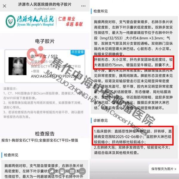 直肠癌赵宗梅3.jpg