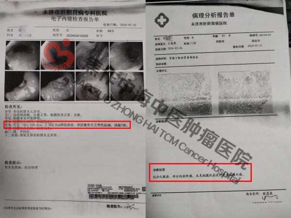 胃癌张秀苗1.jpg