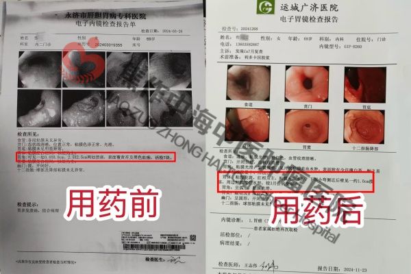 胃癌张秀苗3.jpg