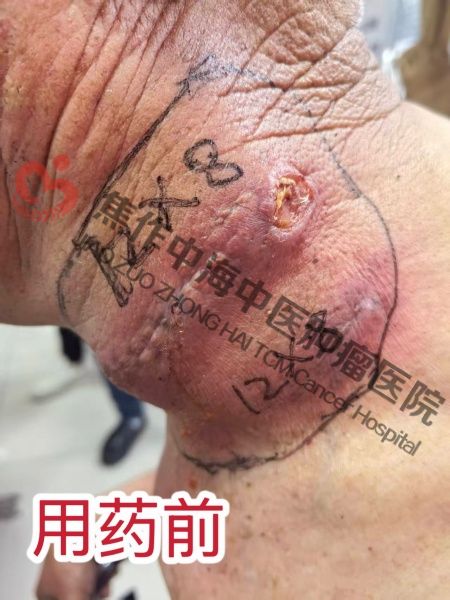 淋巴瘤沈古成1.jpg