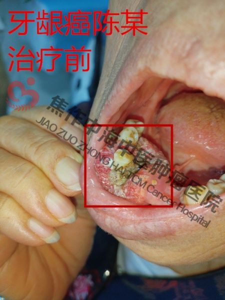 牙龈癌陈权芬2.jpg