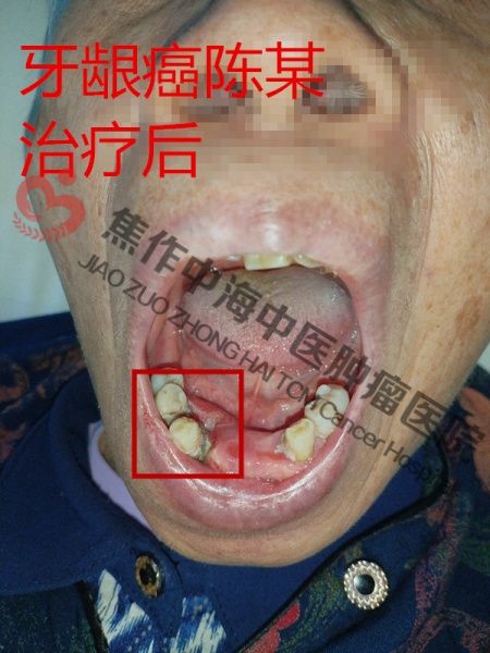 牙龈癌陈权芬3.jpg