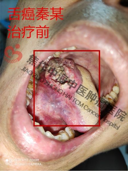 舌癌秦良1.jpg