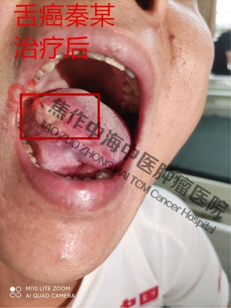 舌癌秦良2.jpg