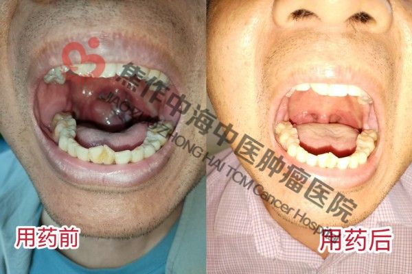 口咽癌王泽领.jpg
