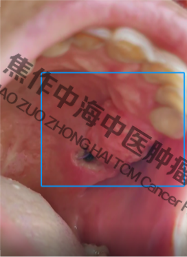 牙龈癌王某1.png