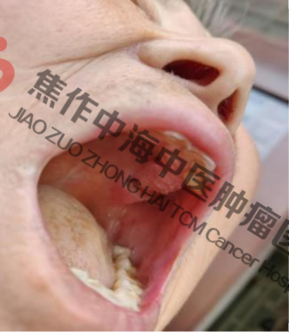 牙龈癌王某3.png