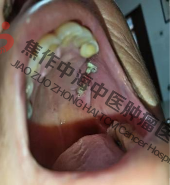 牙龈癌王某4.png