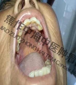 牙龈癌王某5.jpg