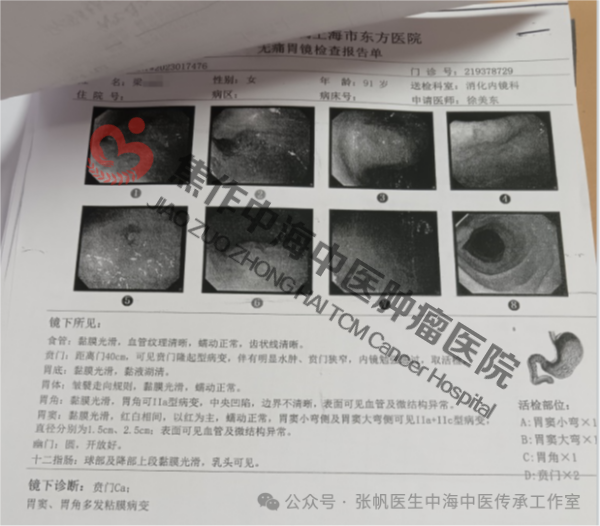 贲门癌梁尚凤1.png