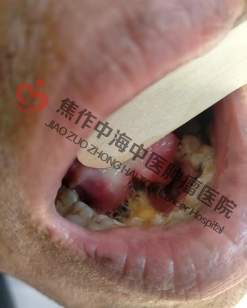舌癌罗志伟2.png