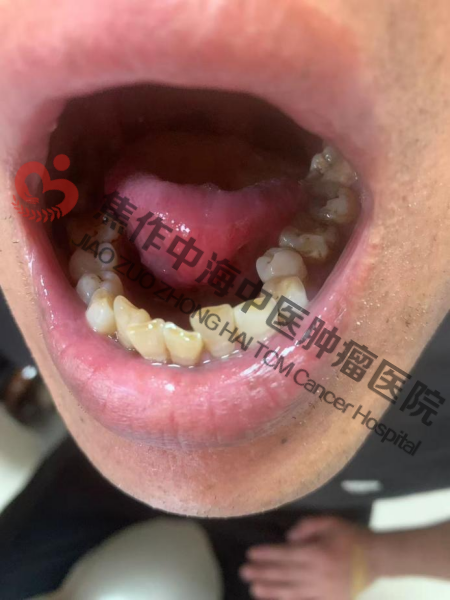 舌癌罗志伟4.png
