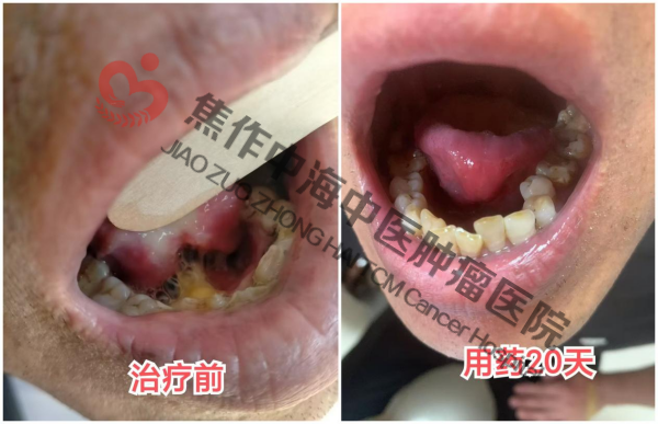 舌癌罗志伟5.png
