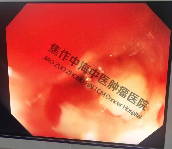 食道癌何德新2.jpg
