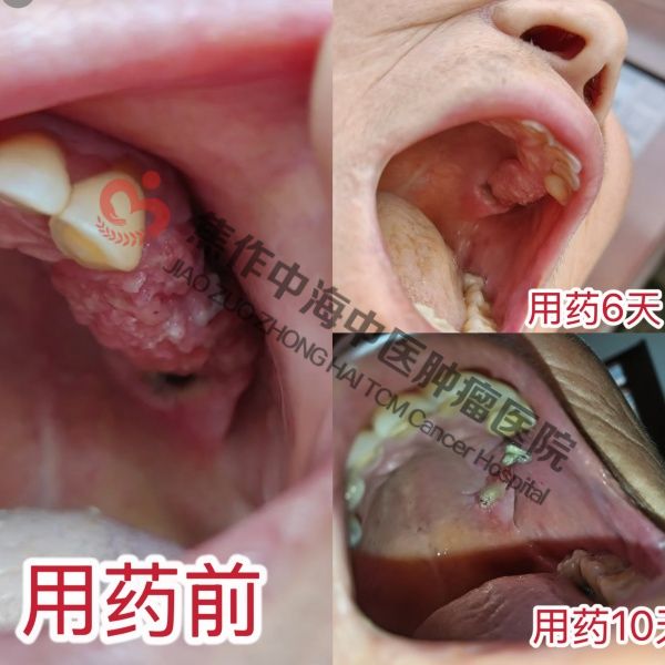 牙龈癌王守兰.jpg